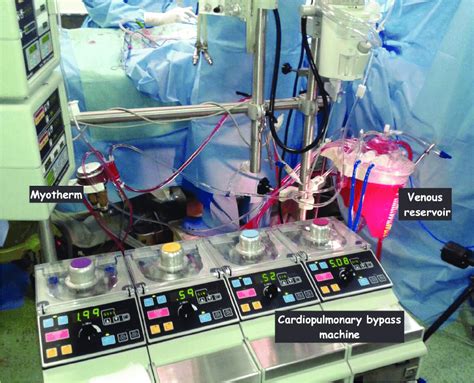 centrifugal pump system cardiopulmonary bypass|cardiopulmonary bypass machine cost.